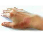 ¿Cuáles son los síntomas del Lupus?
