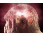 ¿Cuáles son los síntomas de un derrame cerebral?