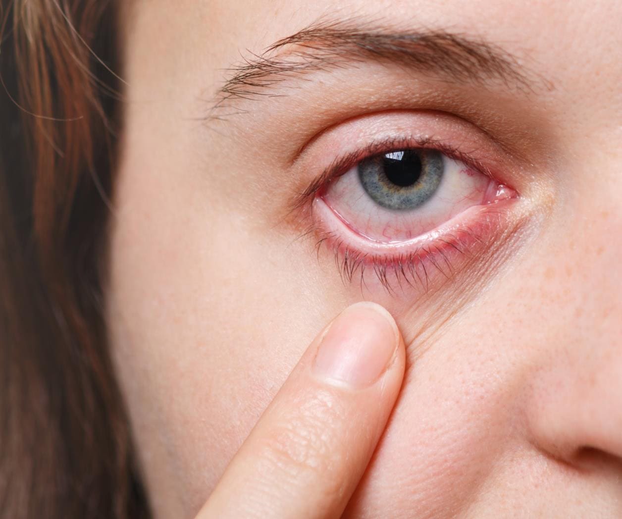 Preocupa alta incidencia de conjuntivitis