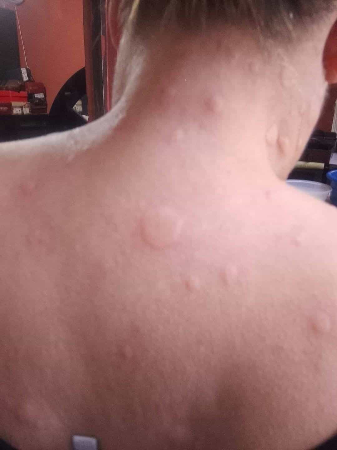 Atacan mosquitos en zona poniente