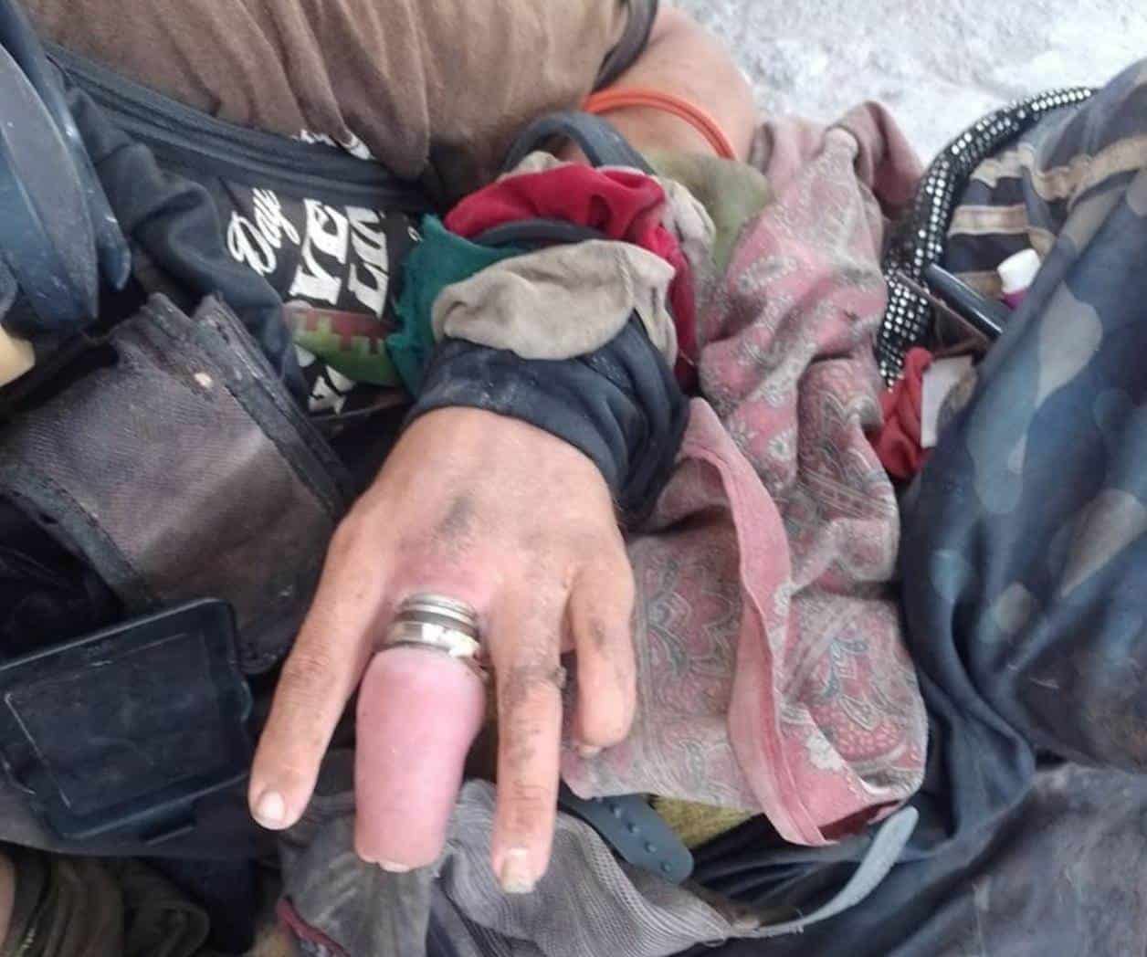 Podría perder un dedo joven con discapacidad